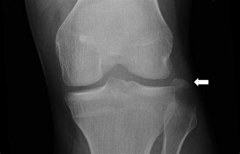 The Knee Resource Posterolateral Corner Injury