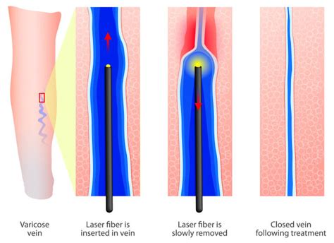 Radiofrequency Ablation Tampa Cardio