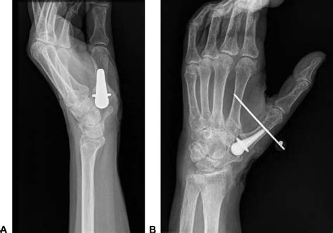 Failed Suture Button Suspensionplasty Of The Thumb Carpometacarpal