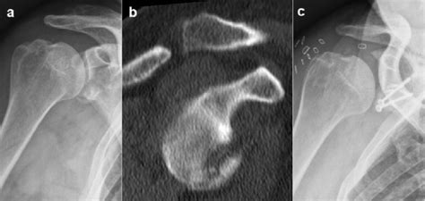 Case Example Of A Large Glenoid Rim Fracture And A Latarjet Procedure