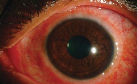 Lesson Conjunctivitis Know Your Differentials