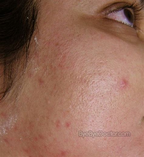 Sebaceous Hyperplasia Causes Treatment Removal Prevention