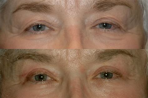 Eyelid Surgery Blepharoplasty Charleston Sc Eye Lift