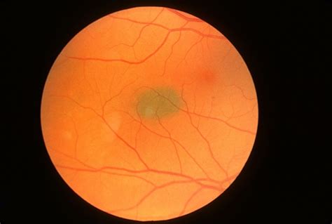 Choroidal Nevus Retina Image Bank