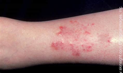 Stasis Dermatitis Symptoms And Causes National Eczema Association