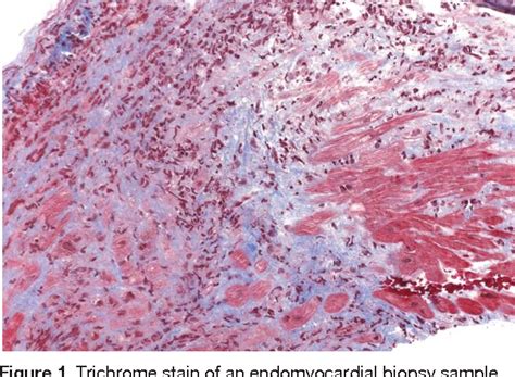 Figure 1 From Management Of A Patient With Eosinophilic Myocarditis And