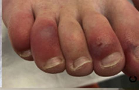 Toes Can Be Telling Sign Of Lasting Impact Of Covid Says New Research