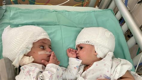 Conjoined Twins Joined At The Head Are Separated After 12 Hour Surgery