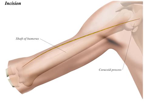 Anterolateral Approach To Distal Humerus Approaches Orthobullets