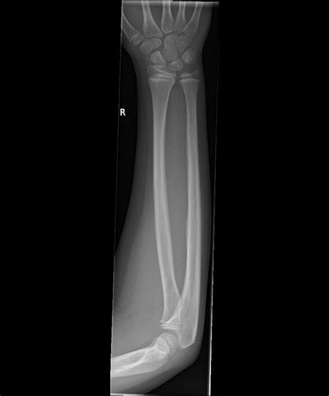 Normal Forearm X Ray