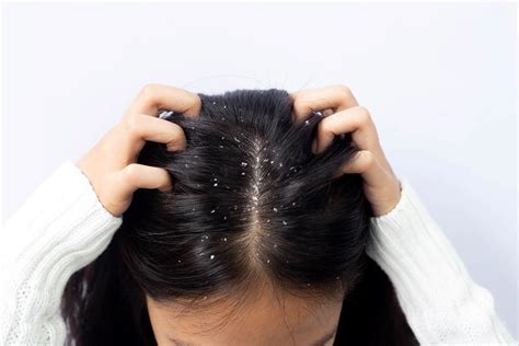 Reasons For Dandruff In Summer Head And Shoulders In