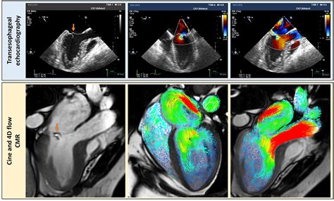 Frontiers A Systematic Review Of 4d Flow Mri Derived Mitral