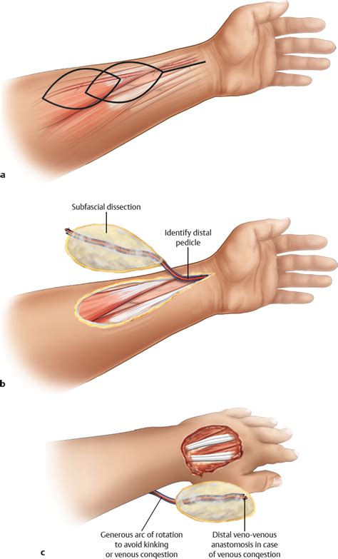 Radial Forearm Flap Plastic Surgery Key
