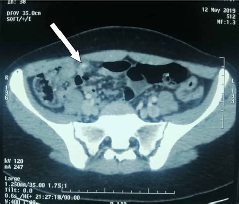 Cureus Fishbone Induced Appendicitis A Case Report