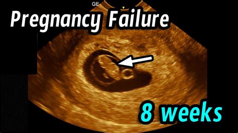 Early Pregnancy Failure 8 Weeks 2 Days Youtube