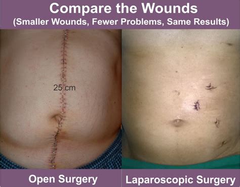 What Are The Advantages Of Laparoscopy Versus Open Surgery