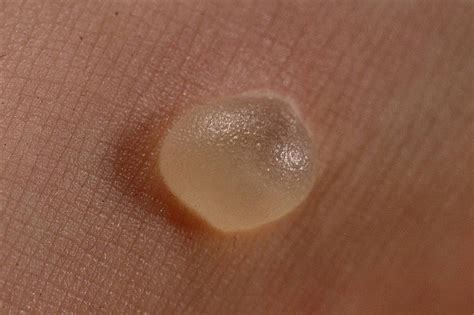 5 Simple Ways To Get Rid Of Blisters