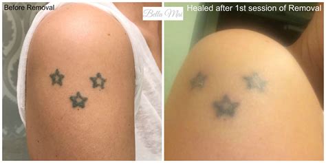 If that's the case, do not despair! Salt and Saline Tattoo Removal | Picosure tattoo removal ...