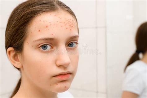 Face Of A Teenage Girl With Pimples Acne On The Skin She Looks At