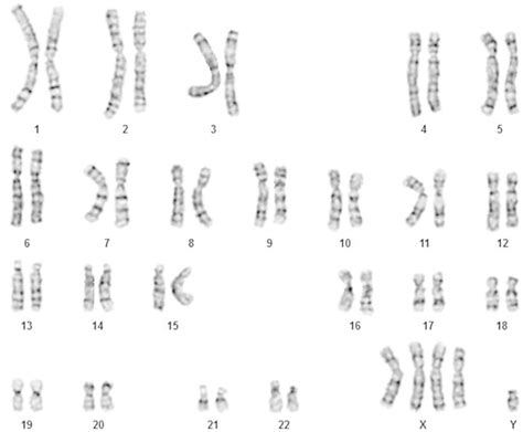 49 xxxxy karyotype gtg banding download scientific diagram