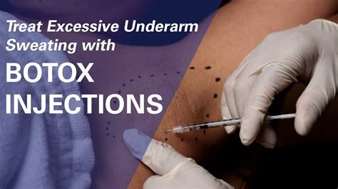 Using Botox For Excessive Sweating In Underarms Zo Skin Centre Youtube