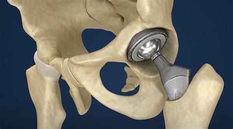 On The Ball With Hip Implants New Equipment Digest