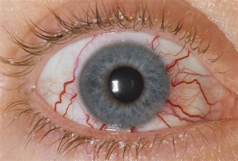 Red Ring Around Iris Eyelids Eye Socket In Babies And More American