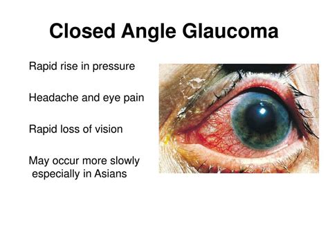 Ppt Acute Angle Closure Glaucoma Powerpoint Presentation Free