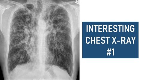 Interesting Chest X Ray 1 Cystic Fibrosis Youtube