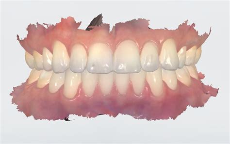 Riverview Dentist Riverview Dental Arts Trios Intra Oral 3d Scanner