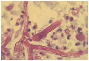 El sello de la mucormicosis es la invasión vascular por hifas que conduce a la trombosis arterial, infarto secundario, trombosis venosa y hemorragia consecuente. Mucormicosis rinocerebral fulminante | Actas Dermo ...