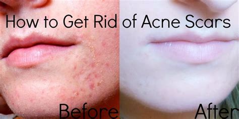 How To Get Rid Of Acne Scar Tissue How To Get Rid Of A Pimple Inside