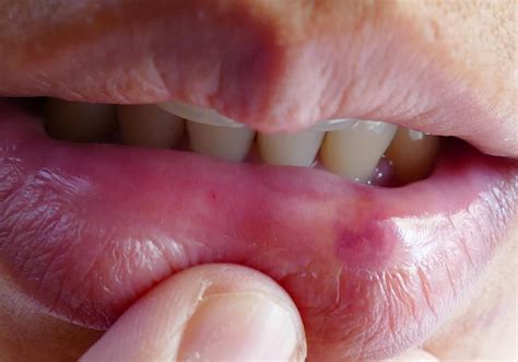 Busted Lip 9 Treatments And Home Remedies