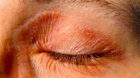 Typische Neurodermitis Symptome Hautinfo At
