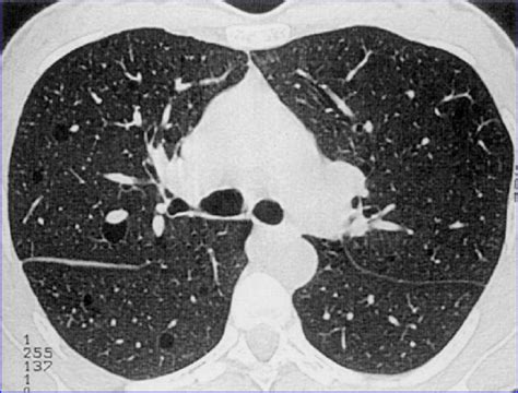Chest Ct Scan Showing A Few Thin Walled Cysts Throughout The Lung