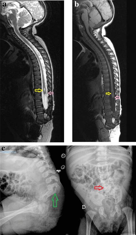 A B T2w Image And T1 W Images Show Abrupt Termination Of The Spinal