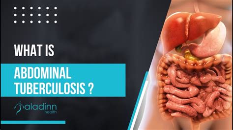 What Is Abdominal Tuberculosis Youtube