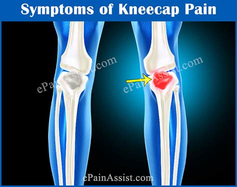 Kneecap Paincausessymptomstreatmentrecovery Periodbraceshome