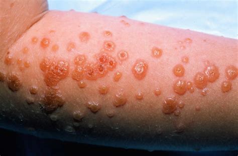 Erythema Multiforme Causes Types Symptoms Diagnosis And Treatment
