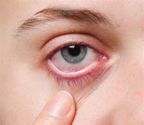I Sintomi Della Sindrome Dell Occhio Secco Poliambulatorio Pcm
