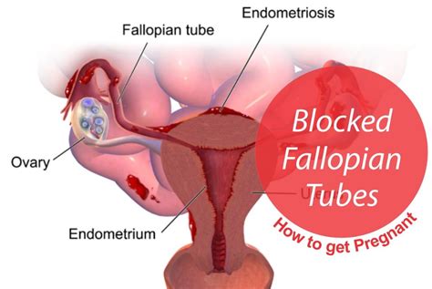 Steps To Get Pregnant With Blocked Fallopian Tubes Antvt Com