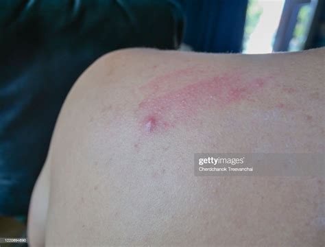 Insect Bite And Skin Allergic On The Back High Res Stock Photo Getty