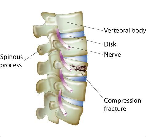 Compression Fractures Of The Spine Dr Lani Simpson