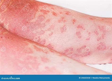 Large Redinflamedscaly Rash On Man S Legsacute Psoriasis Severe