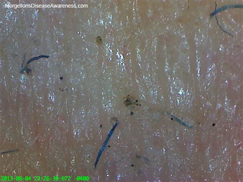 Morgellons Disease Awareness Morgellons Fibers Skin Many People Have