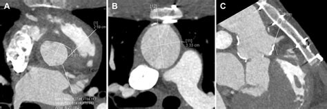 Thoracic Ct Images Demonstrating Aortic Root Measurements Download