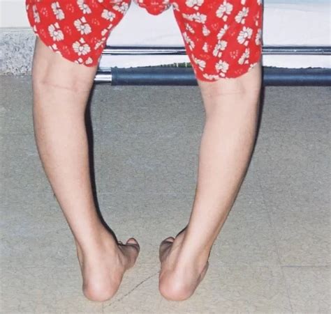 Bow Leg Genu Varum Causes Symptoms Treatment