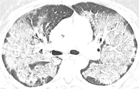 Pneumocystis Jiroveci Pneumonia High Resolution Ct Findings In