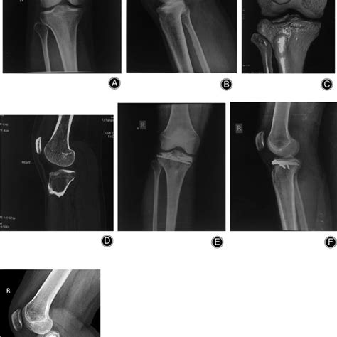 A1 Anteromedial Tibial Plateau Fracture A2 Anterior Medial Approach
