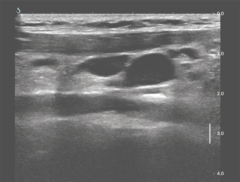 Vietnamese Medic Ultrasound Case 435 Cervical Lymph Nodes Dr Phan